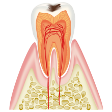 C1（エナメル質の虫歯）