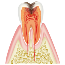 C3（神経の虫歯）