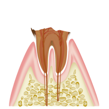 C4（末期の虫歯）