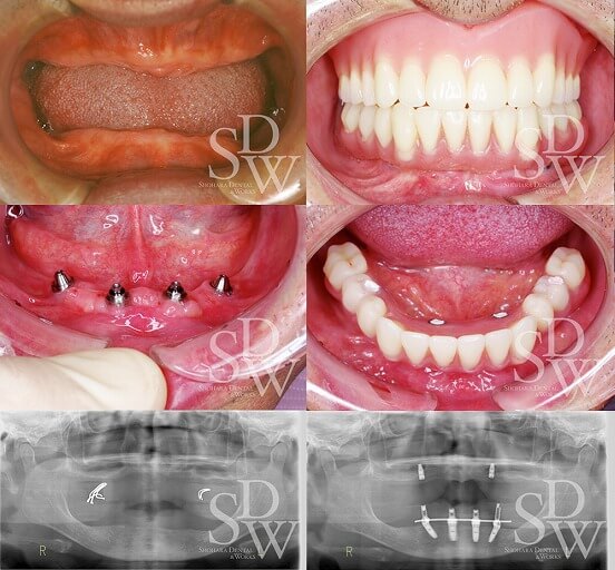 上顎インプラント義歯、下顎オールオン４即時荷重の症例