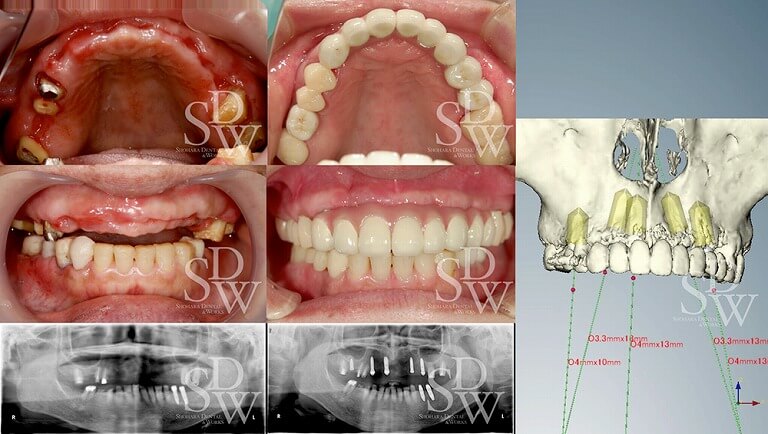 上顎前歯部即時荷重、臼歯部ソケットリフトの症例