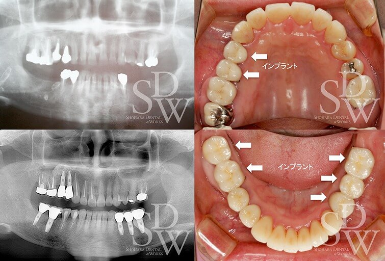下顎臼歯部をインプラントで咬合再建したフルマウスの症例