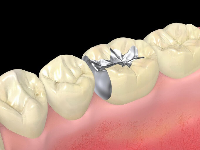 詰め物・被せ物からくる金属アレルギーって？