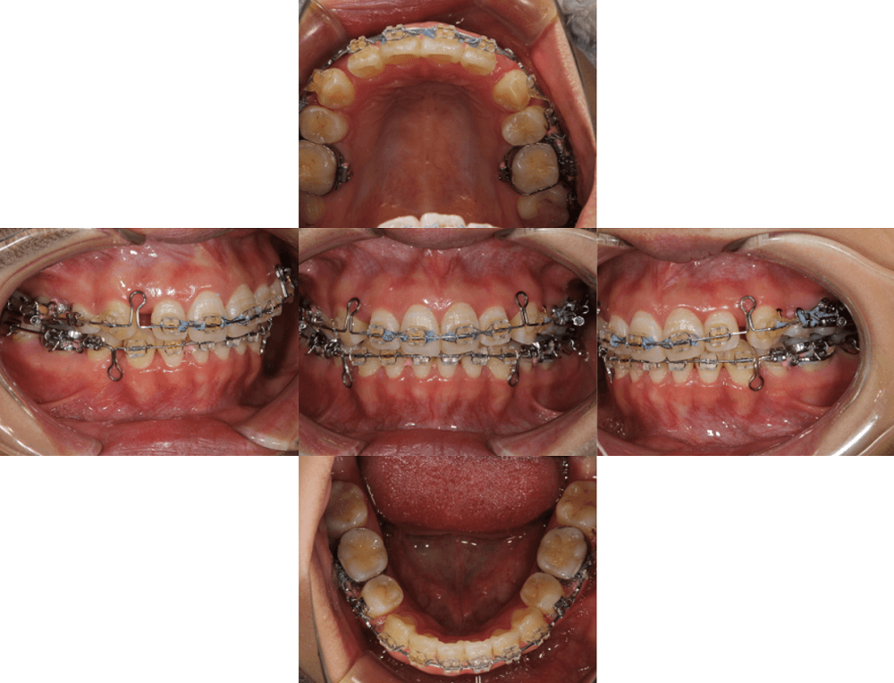 治療例　２期治療（歯の矯正）：歯の位置の修正を行います