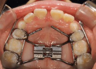 治療中：上あご（拡大装置）