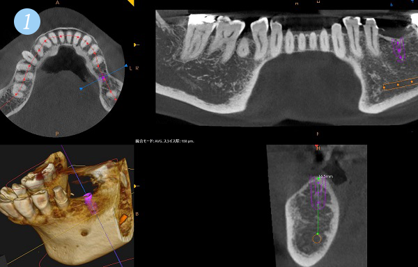 CTによる3Dシミュレーションで術前に埋入位置、骨の状態を確認します。