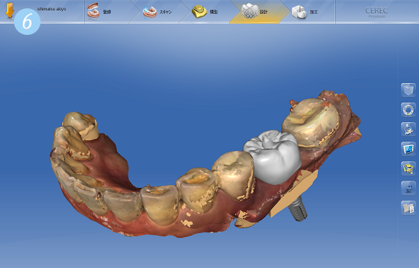セレックで仮歯の設計、ミリングをおこいます