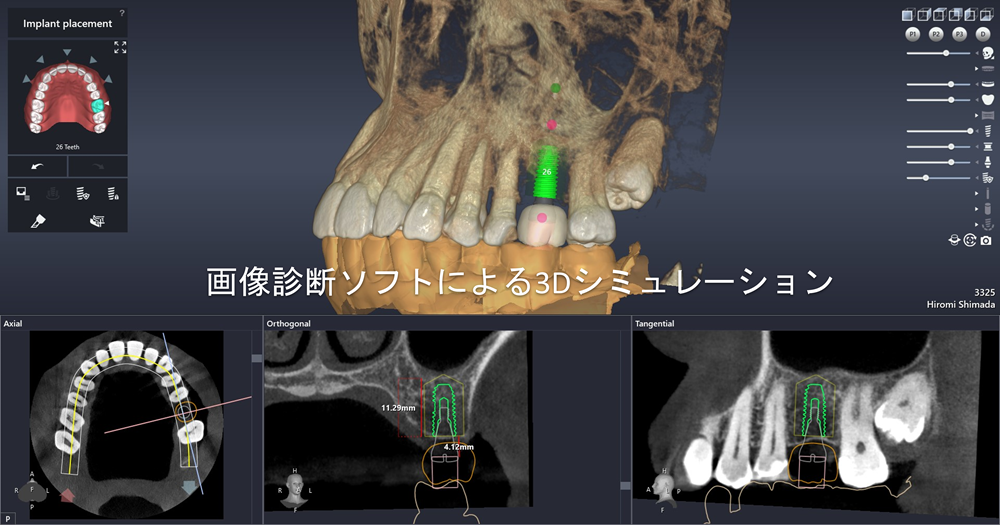 ３D画像診断から全症例で手術用ガイドを作製