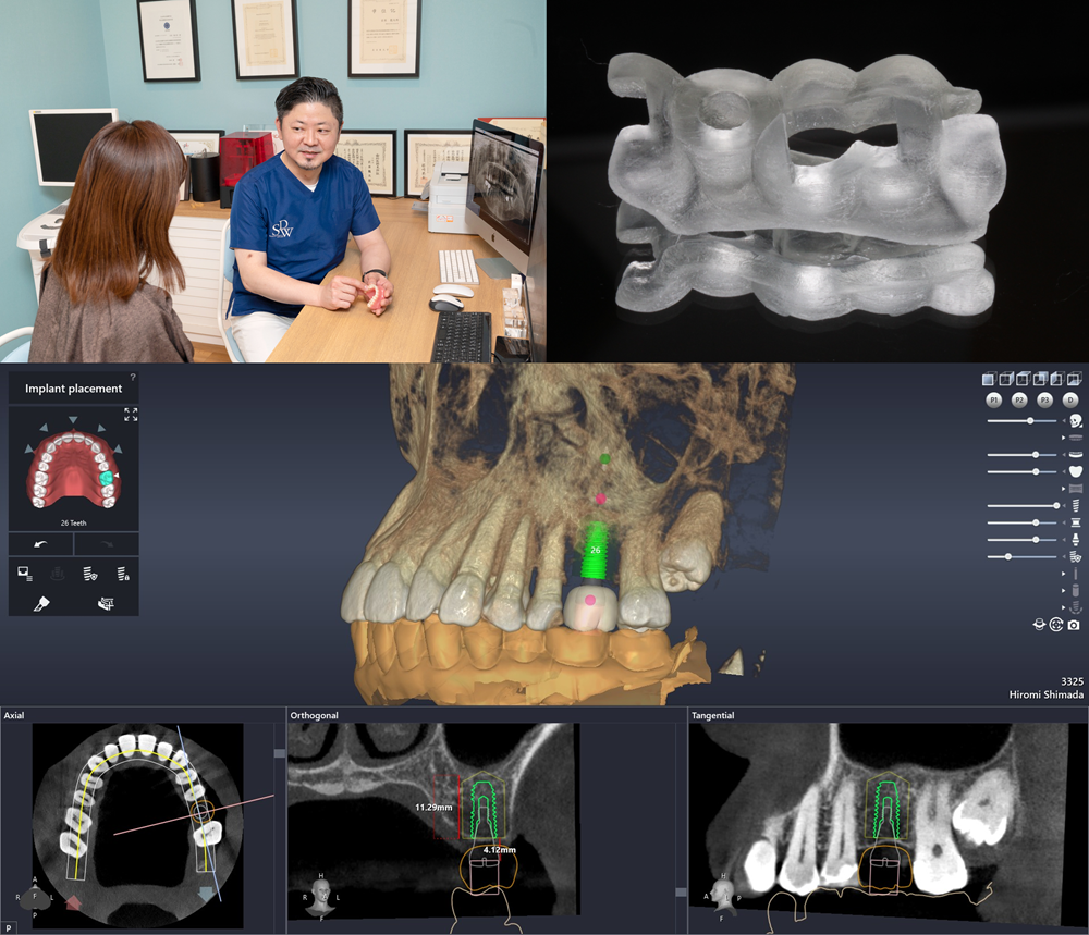 3Dシミュレーションのご説明と手術用ガイド作製