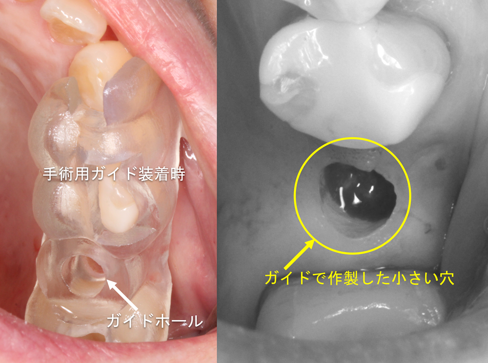 痛み、腫れが少ないフラップレスインプラント