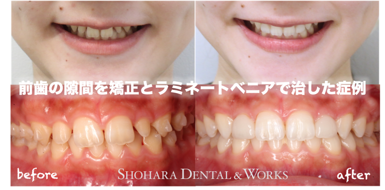 インビザライン、セラミック：前歯の隙間を矯正とラミネートベニアで治した症例