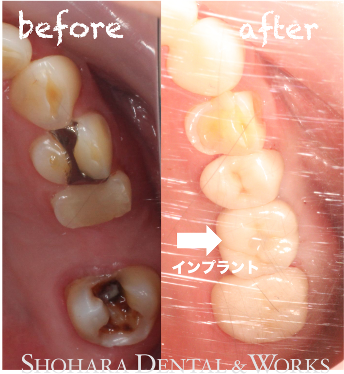 インプラント：左上の歯の欠損をインプラントで短期間で治した症例