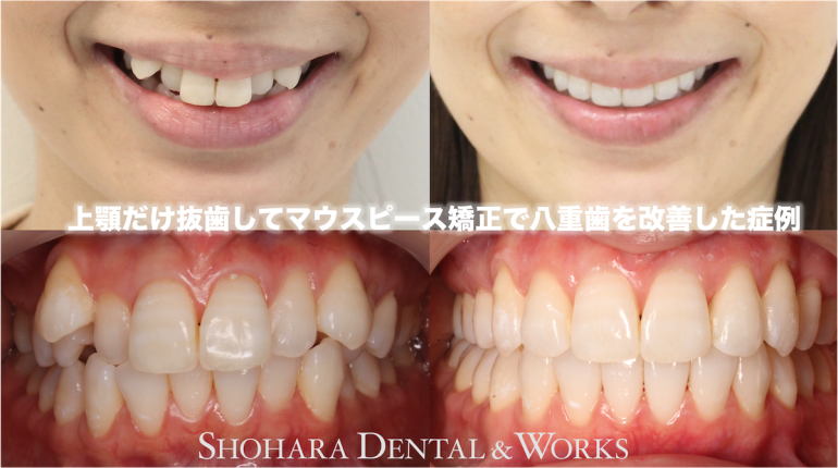 上顎だけ抜歯してマウスピース矯正で八重歯を改善した症例