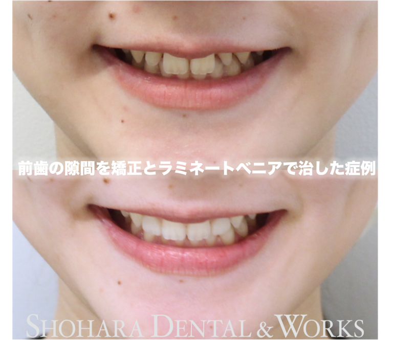 前歯の隙間を矯正とラミネートベニアで治した症例