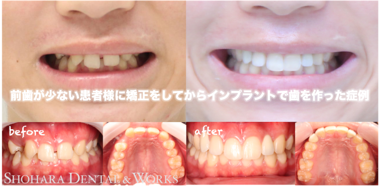 インビザライン、インプラント：前歯が少ない患者様に矯正をしてからインプラントで歯を作った症例