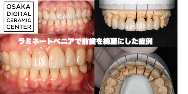 セラミック：ラミネートベニアで前歯を綺麗にした症例