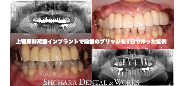 インプラント：上顎即時荷重インプラントで前歯のブリッジを1日で作った症例