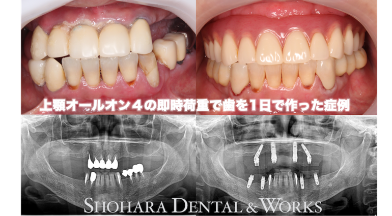 インプラント：上顎オールオン４の即時荷重で歯を1日で作った症例