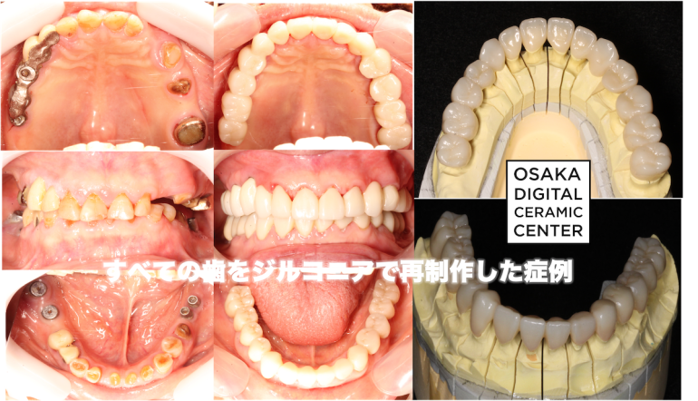 セラミック：咬合再構成して全ての歯をジルコニアで再製作した症例